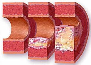 Stages of atherosclerotic plaque development in a hypertensive vessel